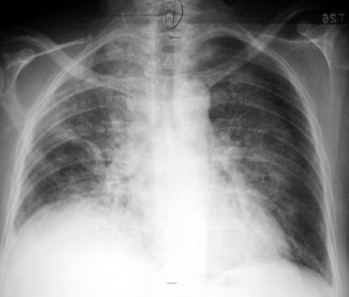 LearntheHeart's tweet photo. Amiodarone lung toxicity: Restrictive pattern on PFTs

Stop drug
Steroids
Many patients improve with time

#USMLE https://t.co/9K9LhfxmMr
