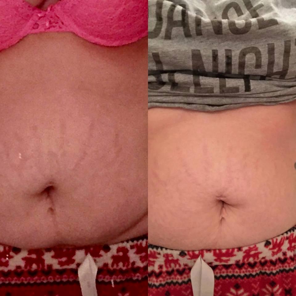tabsetoca1980's tweet photo. 👗 Mother Loses Her Belly Fat with This New 'Skinny Pill'. Exposed: Moms Trick To Losing 20l https://t.co/fmlJpvrIbZ https://t.co/eFYTBJcoYr