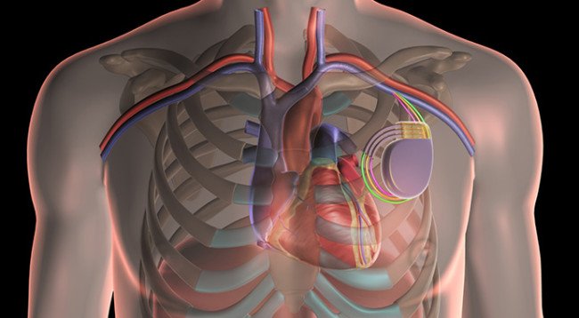 Имплантируемый кардиовертер-дефибриллятор. Кардиовертер-дефибриллятор имплантируемый трехкамерный. Двухкамерный кардиовертер-дефибриллятор. Однокамерный кардиовертер дефибриллятор. Crt-d трехкамерный кардиовертер-дефибриллятор.