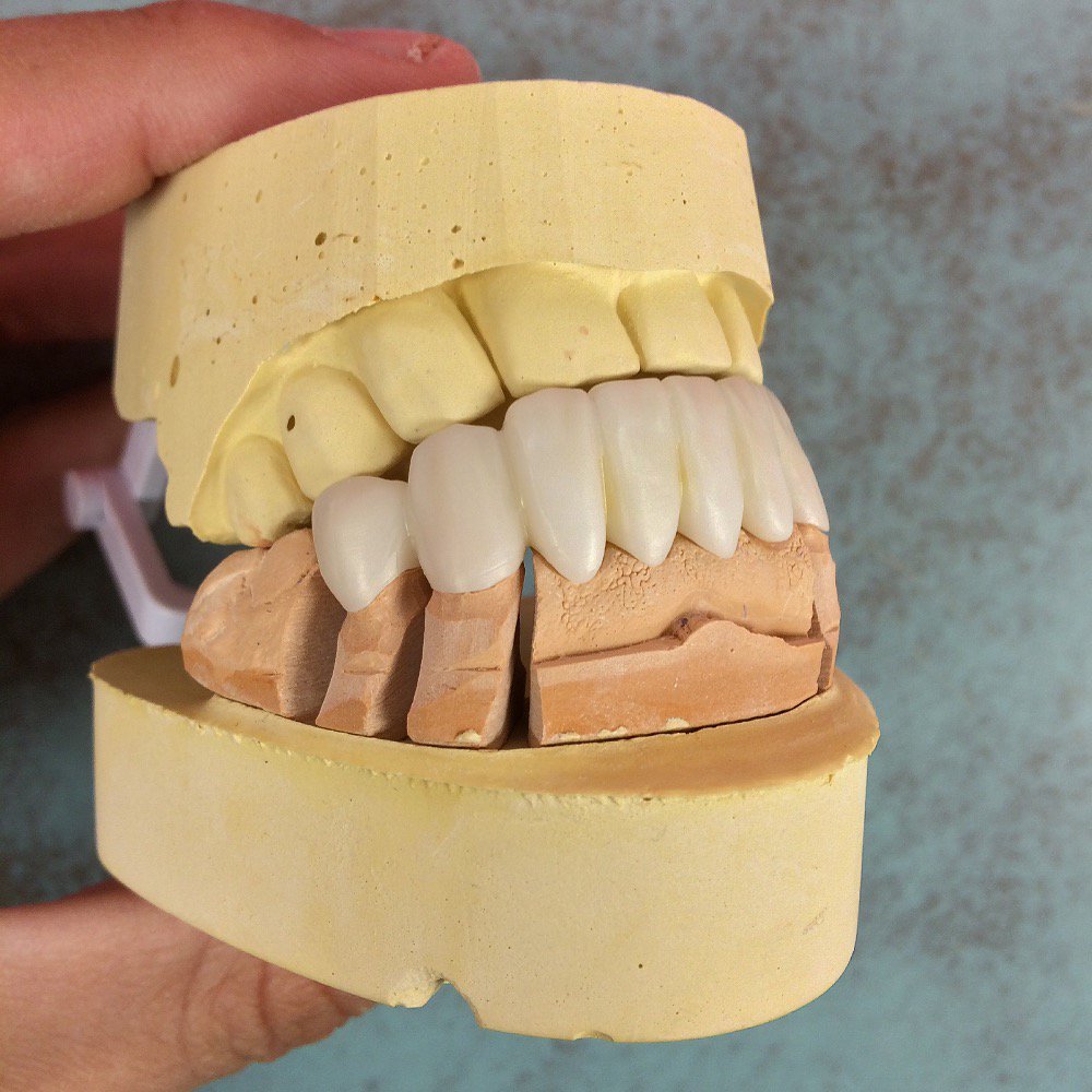 PoseyDentalLab's tweet photo. Lower #zirconia #dentalbridge in progress for a brand new #smile! #poseydentallab #dental #dentistry #dentallab https://t.co/zK8bO6bFhi