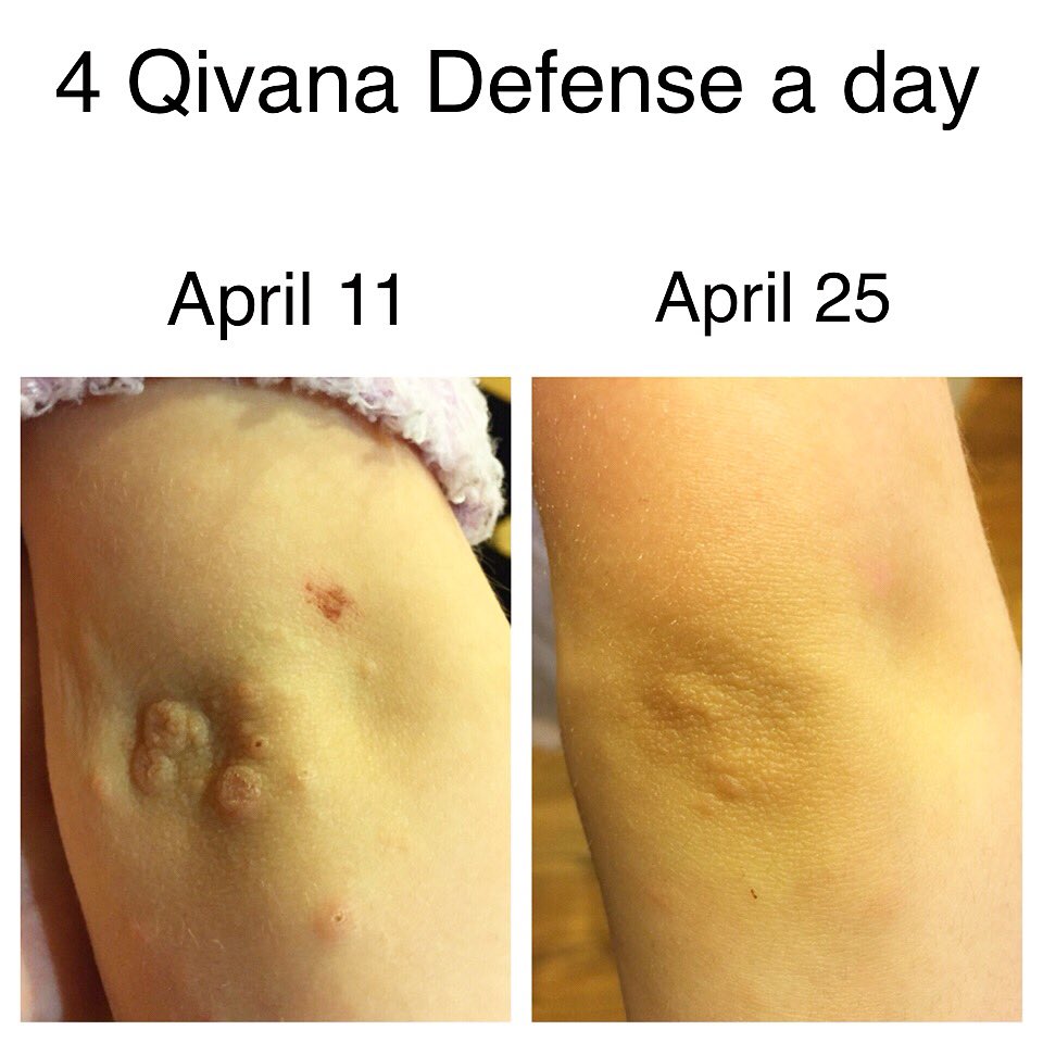 ThePof3's tweet photo. Beat Molluscum Contagiosum #allnaturalproducts #fullyorganic #qivanadefense #qivana #increaseimmunity #safeforkids https://t.co/ojkOKKCcuG