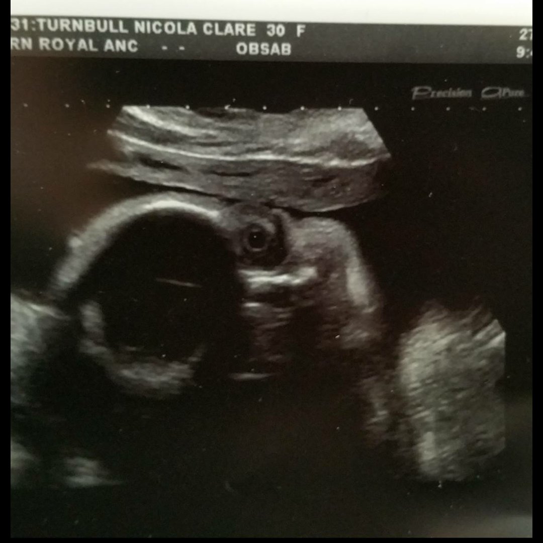 donna_louise80's tweet photo. My niece, not even born and already a bit of a selfie queen 😘 @sessycakes 
#ScanPic #baby #selfie #creepy https://t.co/M8Q4QIvs6I