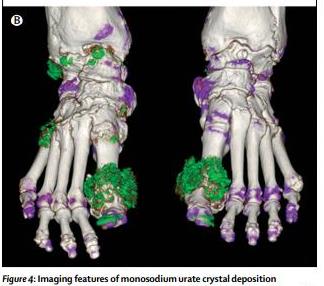 TheLancet's tweet photo. Gout - Summary of advances in understanding, diagnosis &amp; treatment - a new Seminar https://t.co/5JDNYNIgbu https://t.co/Q3LApSB98t