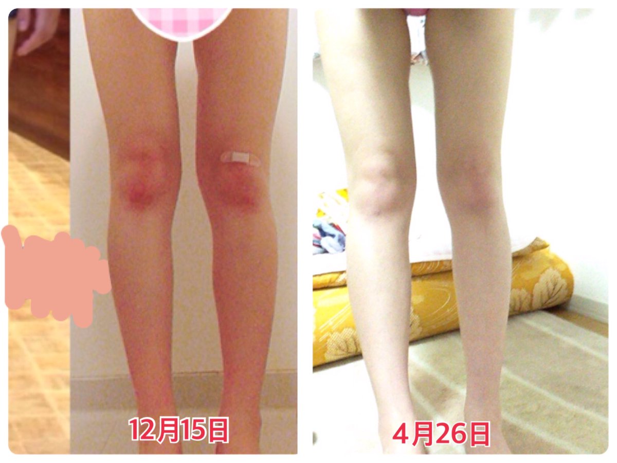 Minorin 自分磨き 衝撃 画像 約4ヶ月でふくらはぎと太ももの肉が落ちてきた 光の加減でわかりにくいかもしれないけど変わったよね 笑 ちなみに筋肉ついたから体重は減ってないよ 拡散希望 少しでも気になった人rt