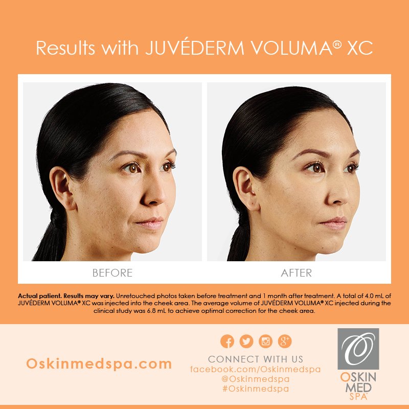 OskinMedSpa's tweet photo. Before &amp; After #JuvédermVolumaXC #OSkinMedSpa #Skincare #Spa #Relax #HealthySkin #BodyTreatments #FacialTreatments https://t.co/cEIrWvaoKu