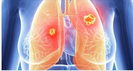MedscapeStudent's tweet photo. #ELCC16: 2 #immunotherapies for advanced NSCLC get results comparable to clinical trials. https://t.co/iYnuDXDTjt https://t.co/7uH4DNO9Ha