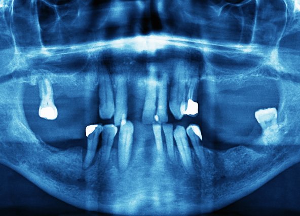 snoozedentistry's tweet photo. How Often Should You Get #Dental X-Rays? #OralHealth https://t.co/EDQDLh37zE https://t.co/WUR522IDO3