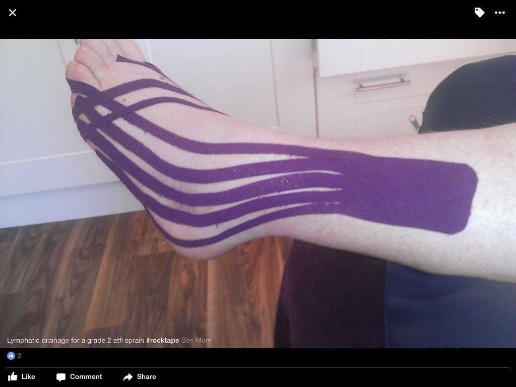 megannifhiach's tweet photo. Lymphatic drainage taping for a grade 2 ATFL sprain @rocktapeuk #OnlyWorkWithTheBest https://t.co/OVUEM74SBc