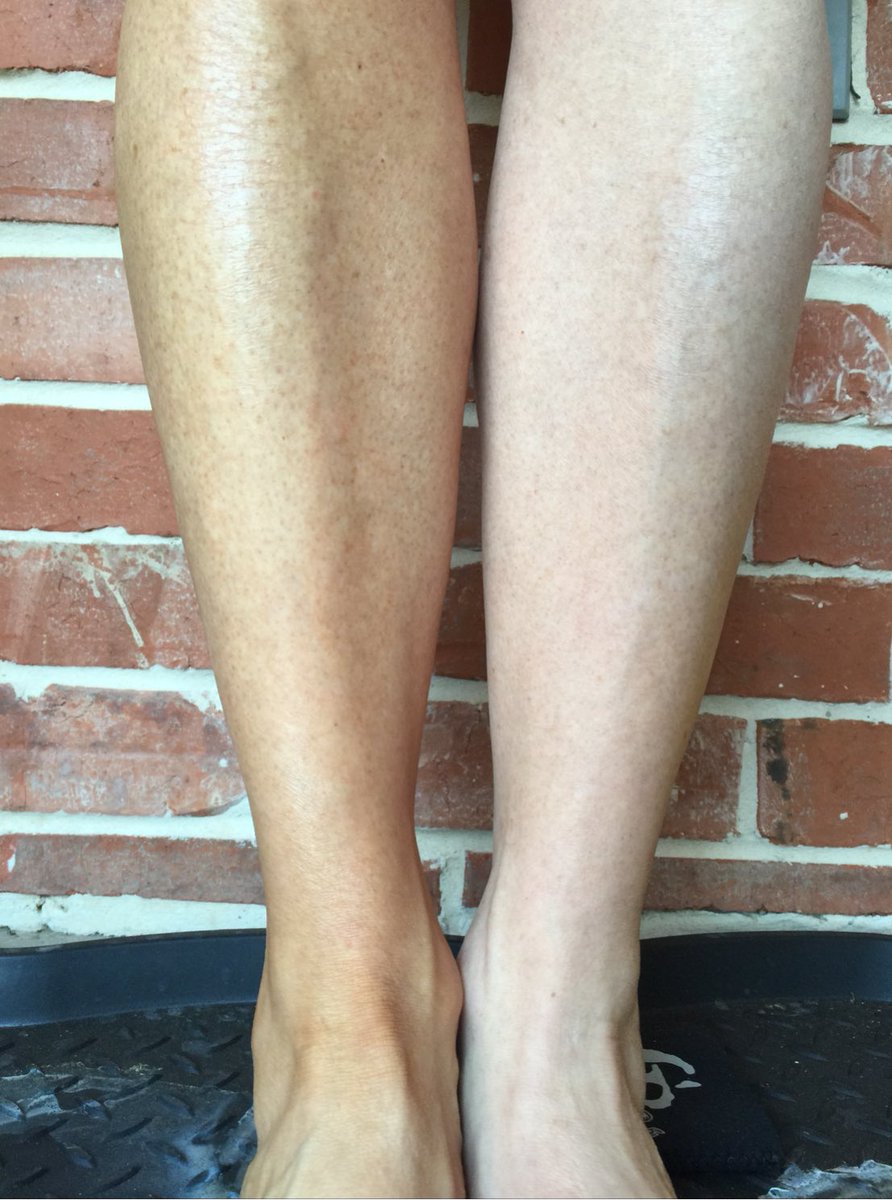 shanna1966's tweet photo. Sunless Tanner $20 #mylegs #rodan+fields #smartchoice https://t.co/LYEFPUbOWd
