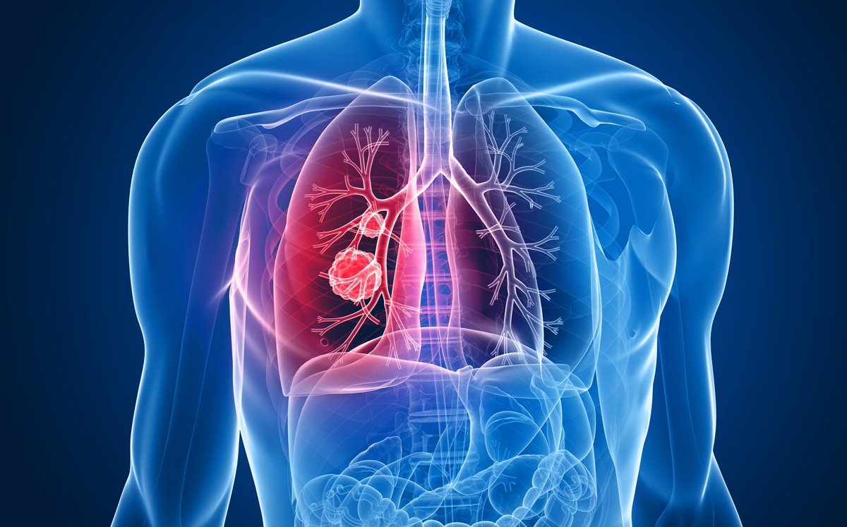 mediazoomhmo's tweet photo. Ofrecen detección gratuita de #cáncer de #pulmón LEE: https://t.co/TRL2E25yfX #TemasQueInteresan #Salud https://t.co/rygQKbRC2Q