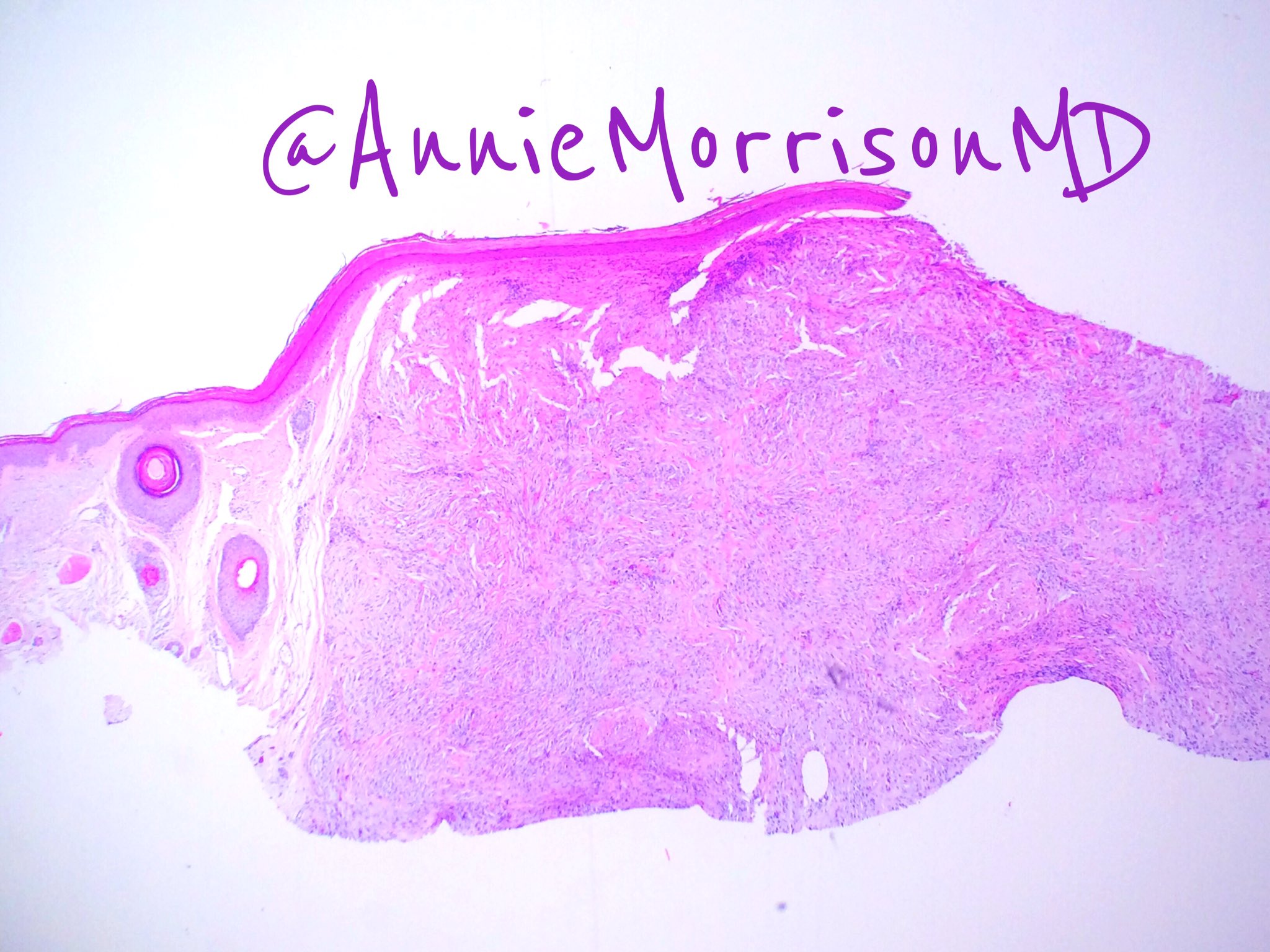 annie-o-morrison-md-on-twitter-cellular-neurothekeoma-don-t-confuse
