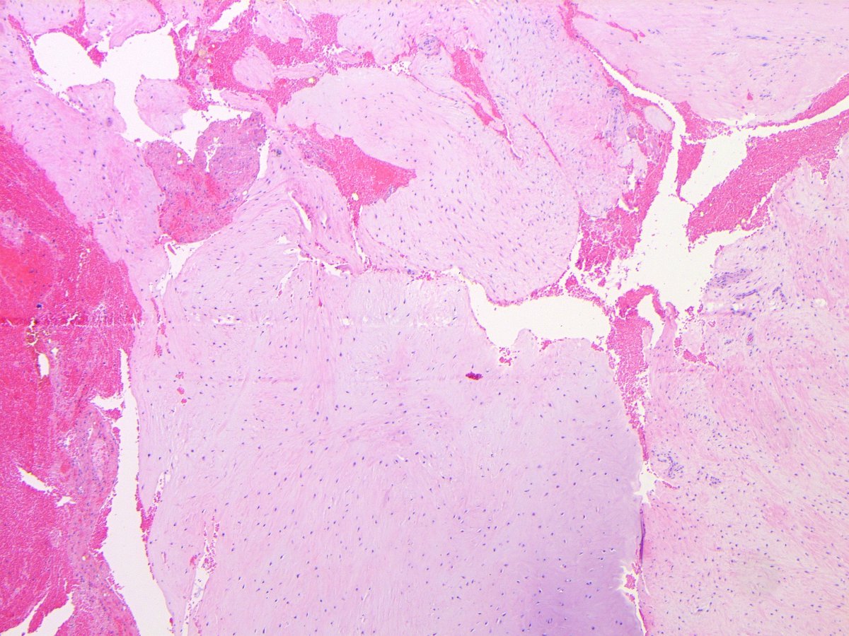 B_C_Dickson's tweet image. RETROPUBIC CARTILAGINOUS CYST. NB: fibrocartilage w/ cystic degeneration &amp;amp; debris; CS mimic (Tan, Clin Radiol, 2012)