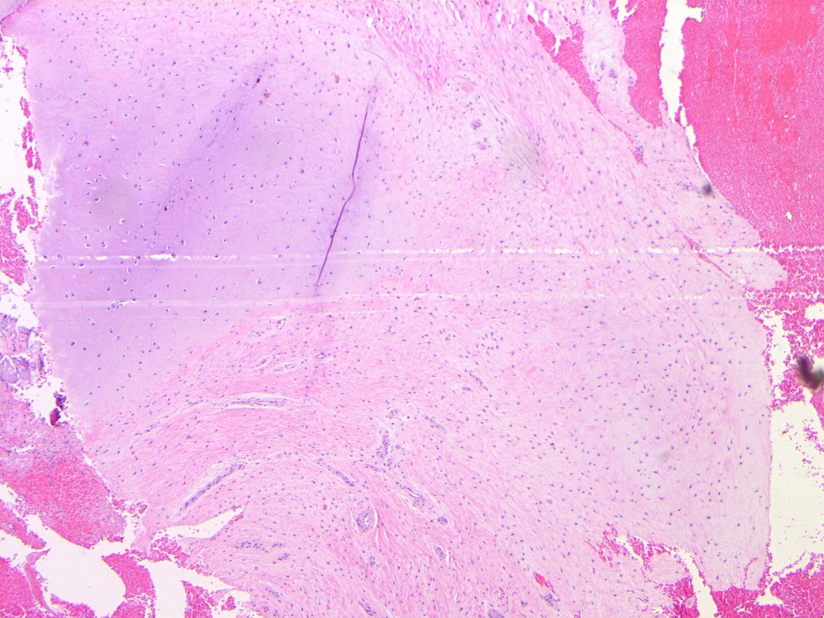 B_C_Dickson's tweet image. RETROPUBIC CARTILAGINOUS CYST. NB: fibrocartilage w/ cystic degeneration &amp;amp; debris; CS mimic (Tan, Clin Radiol, 2012)