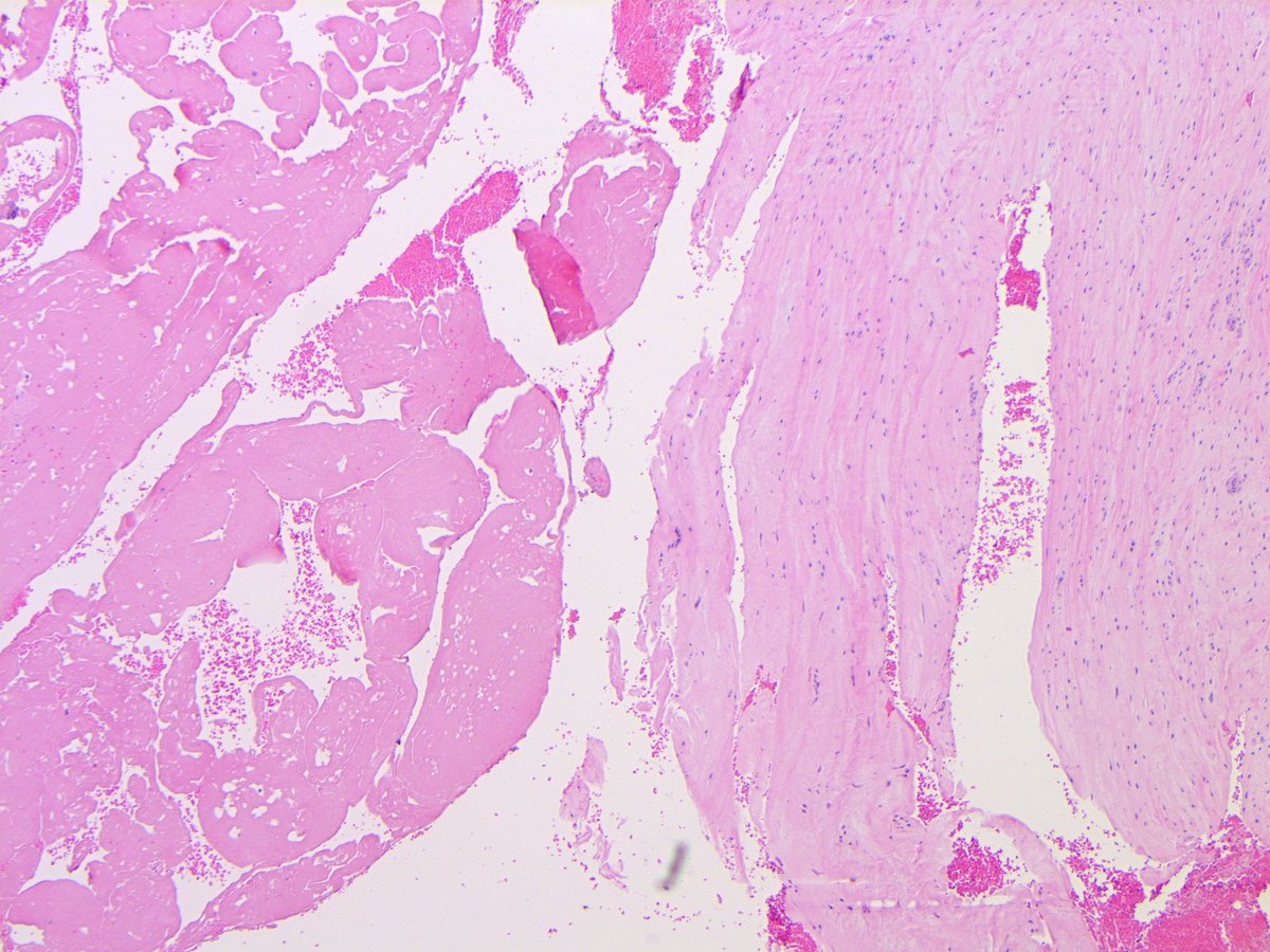 B_C_Dickson's tweet image. RETROPUBIC CARTILAGINOUS CYST. NB: fibrocartilage w/ cystic degeneration &amp;amp; debris; CS mimic (Tan, Clin Radiol, 2012)