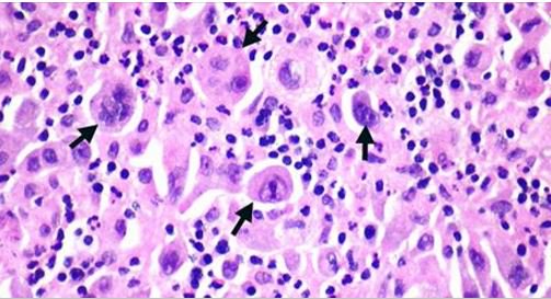MedscapeOnc's tweet photo. #ELCC16 News: Osimertinib activity when used up front in EGFR+ #NSCLC. https://t.co/Q261KYIDwA https://t.co/PrDXyeFpTL