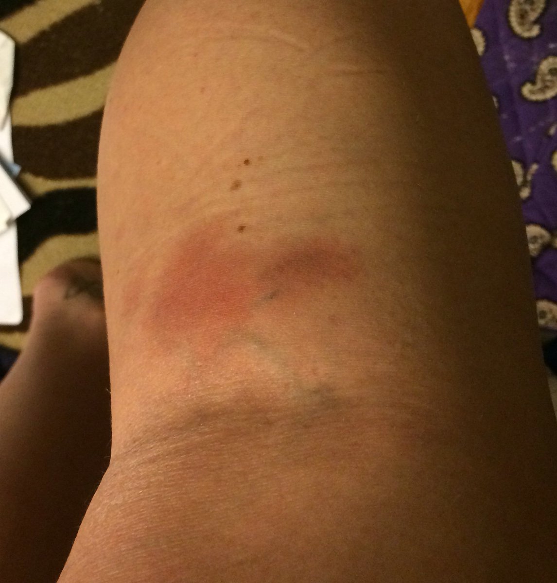 Chrissyc416's tweet photo. When your silk bruises are actually worse than your pole bruises π #aerialproblems https://t.co/zHf9bWjSX8