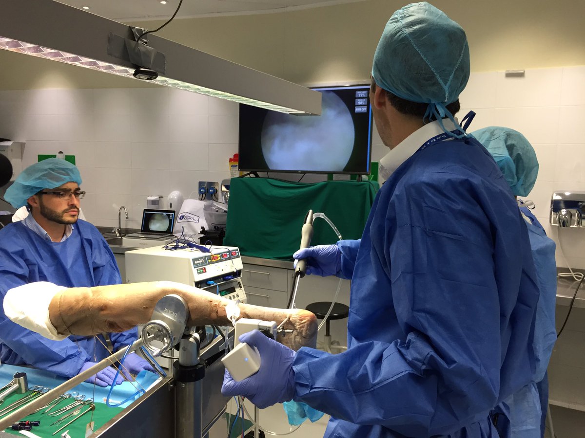 <a href="/DrRamonNavarro/">Dr. Ramón Navarro</a> <a href="/ClinicaCEMTRO/">ClinicaCEMTRO</a> Calcaneoplastia artroscopica con Artroscopio sin cables. colaboración de <a href="/aldimesa/">Aldimesa.Academy</a>