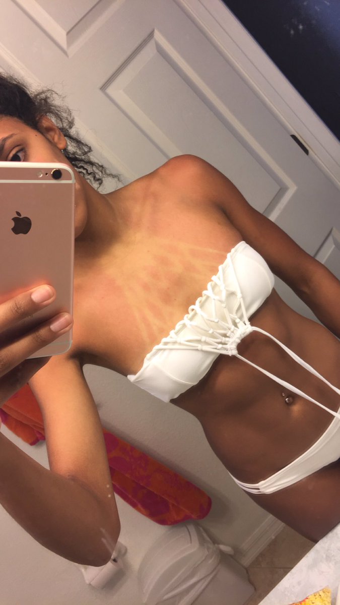 Sunburn