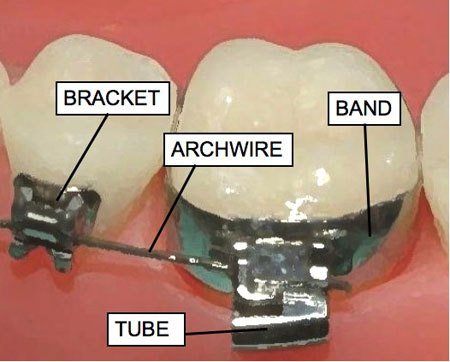 WhiteTeethHome's tweet photo. Definition of #OrthodonticBand - https://t.co/AdwdPS3LBS
#Archwire #OrthodonticBracket #DentalCare #Braces https://t.co/onpO59LeQM