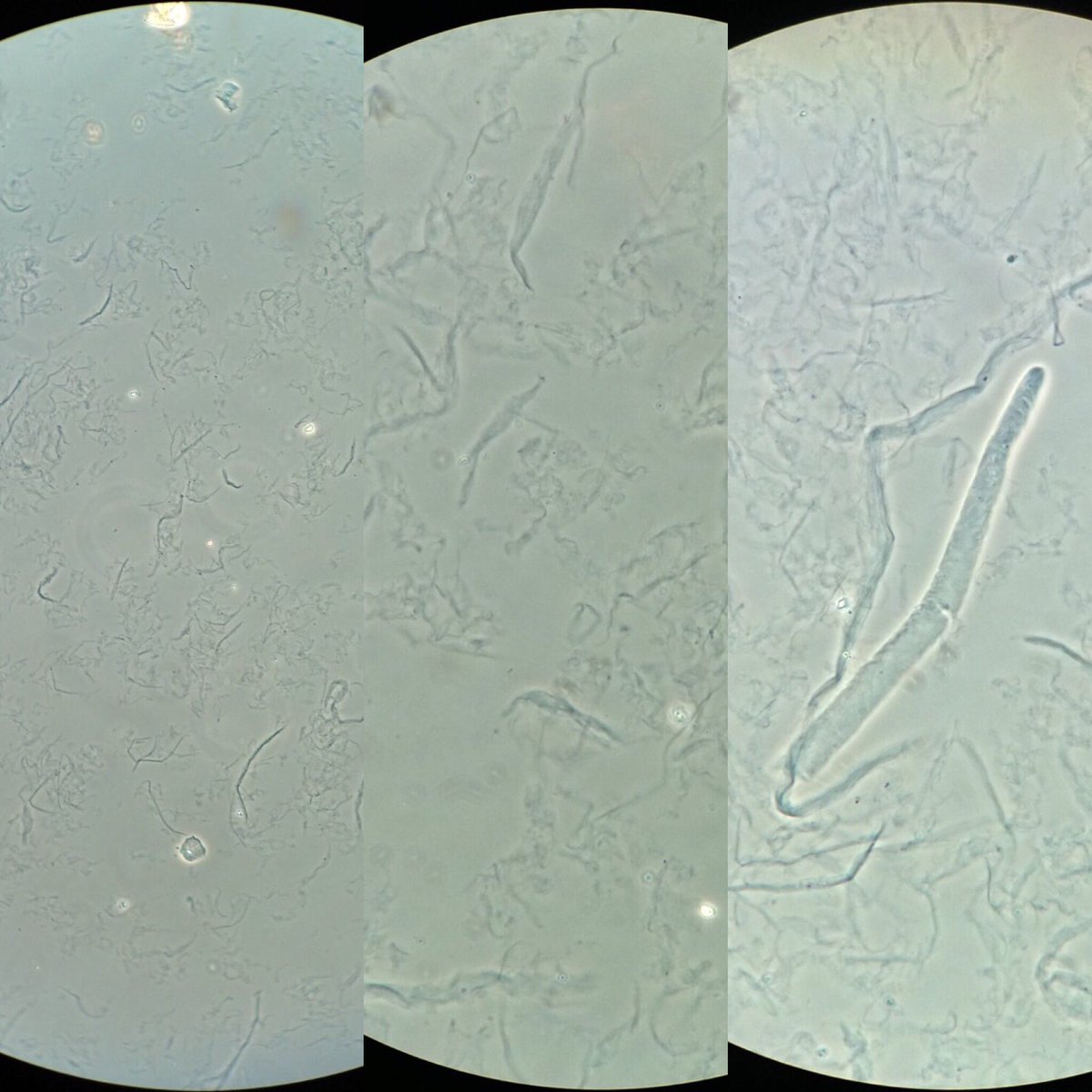 Mucus Threads In Urine Normal Range