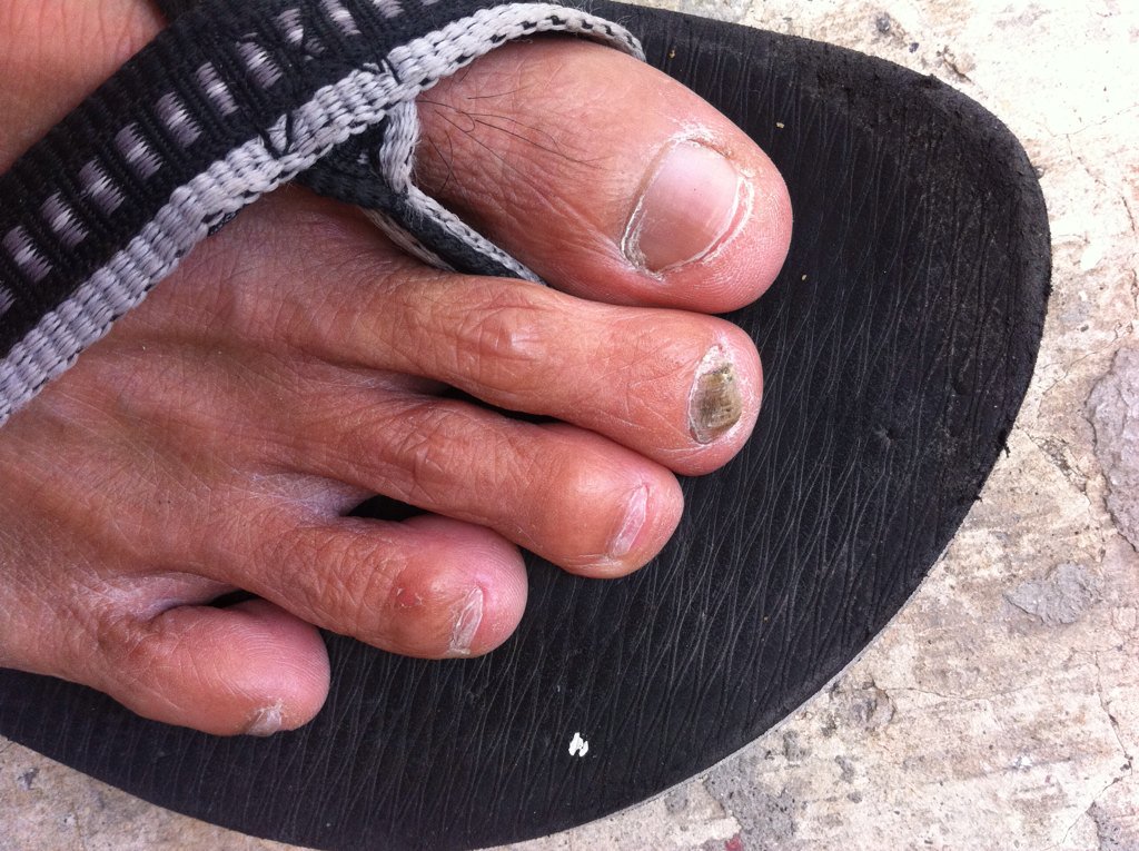 Patay Na Kuko Sa Paa Patay Na Kuko In English Term