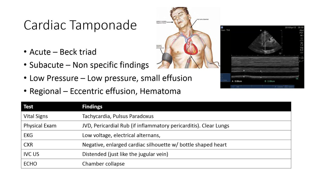SBInternalMed's tweet image. #AMReport: Dr. Rian Shah&apos;s #takehomepoints slide on #cardiac tamponade. #cardiology #meded #FOAMed