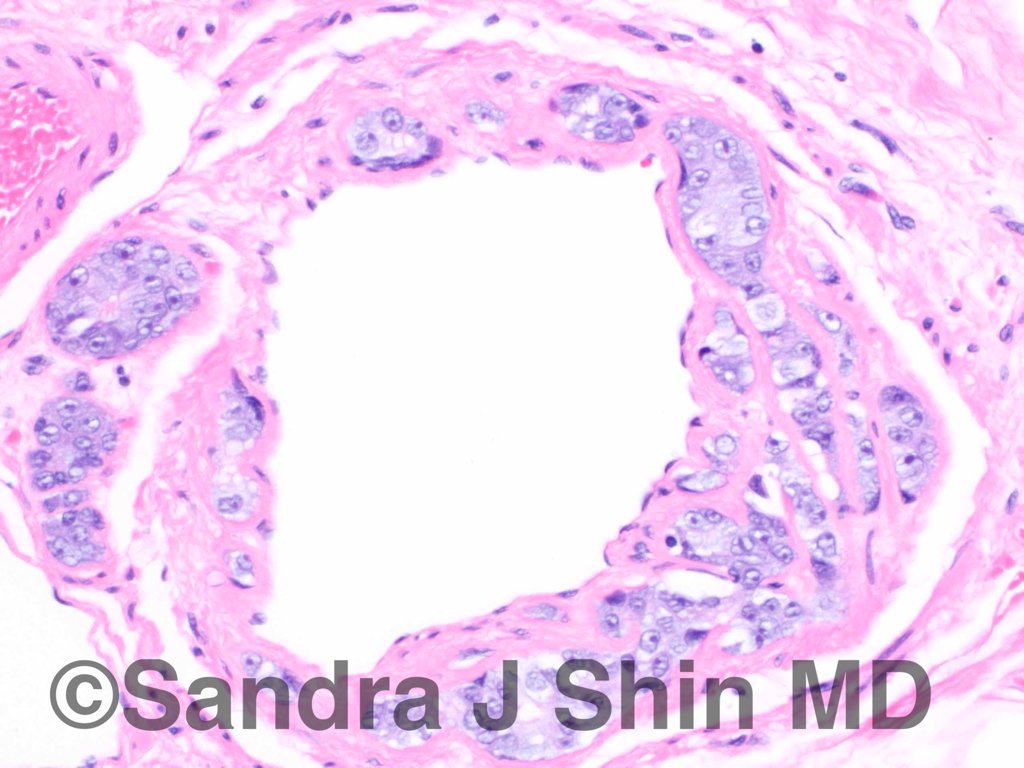 brstpathology's tweet photo. #brstpath High grade DCIS in sclerosing adenosis surrounds lymphatic space, mimicking invasive ductal carcinoma https://t.co/GFly1COZnF