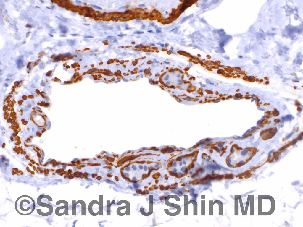 brstpathology's tweet photo. #brstpath High grade DCIS in sclerosing adenosis surrounds lymphatic space, mimicking invasive ductal carcinoma https://t.co/GFly1COZnF