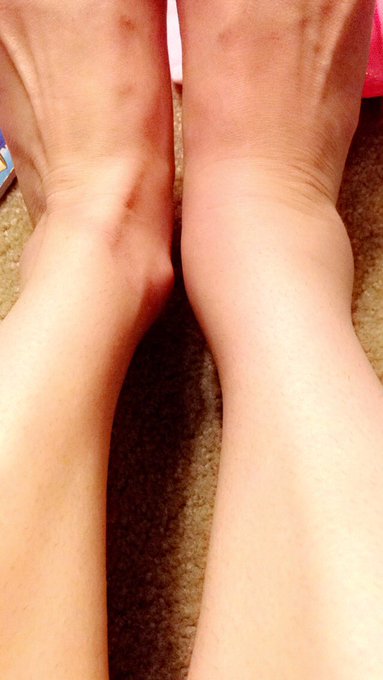 Still pretty bad :( went grocery shopping and it really did work on my ankle https://t.co/8dgIofG1vW