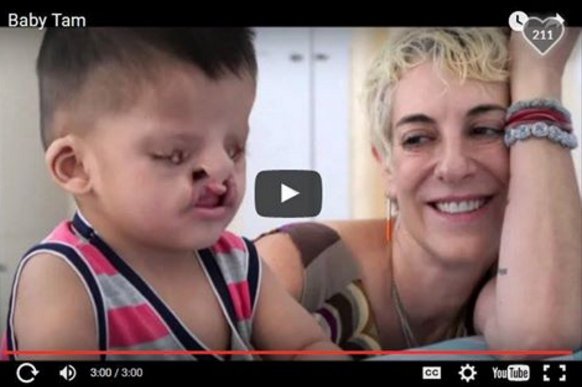 tfishfund's tweet image. Baby Tam had his 1st surgery and is under the care of one of our NGO partners. @HelpingHOW youtube.com/watch?v=MH-VhI…