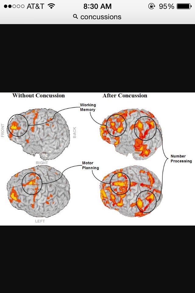 concussions100's tweet image. Ouch... Concussions!