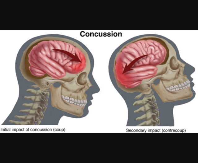 concussions100's tweet image. If you didn't know what a concussion was... Now you know! #cool