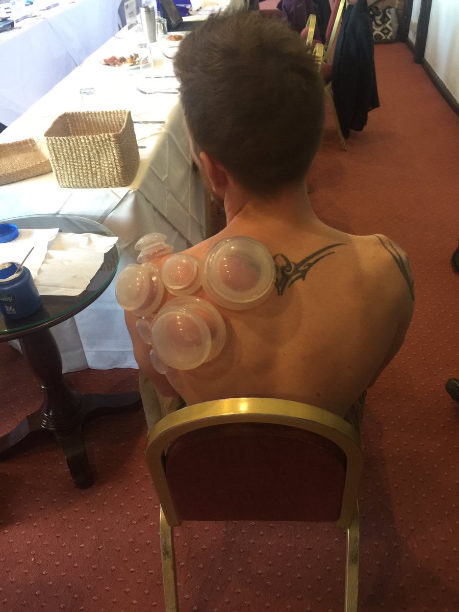 #cupping - the benefits are pain relief, #jointflexibility and increased blood flow to #injuries