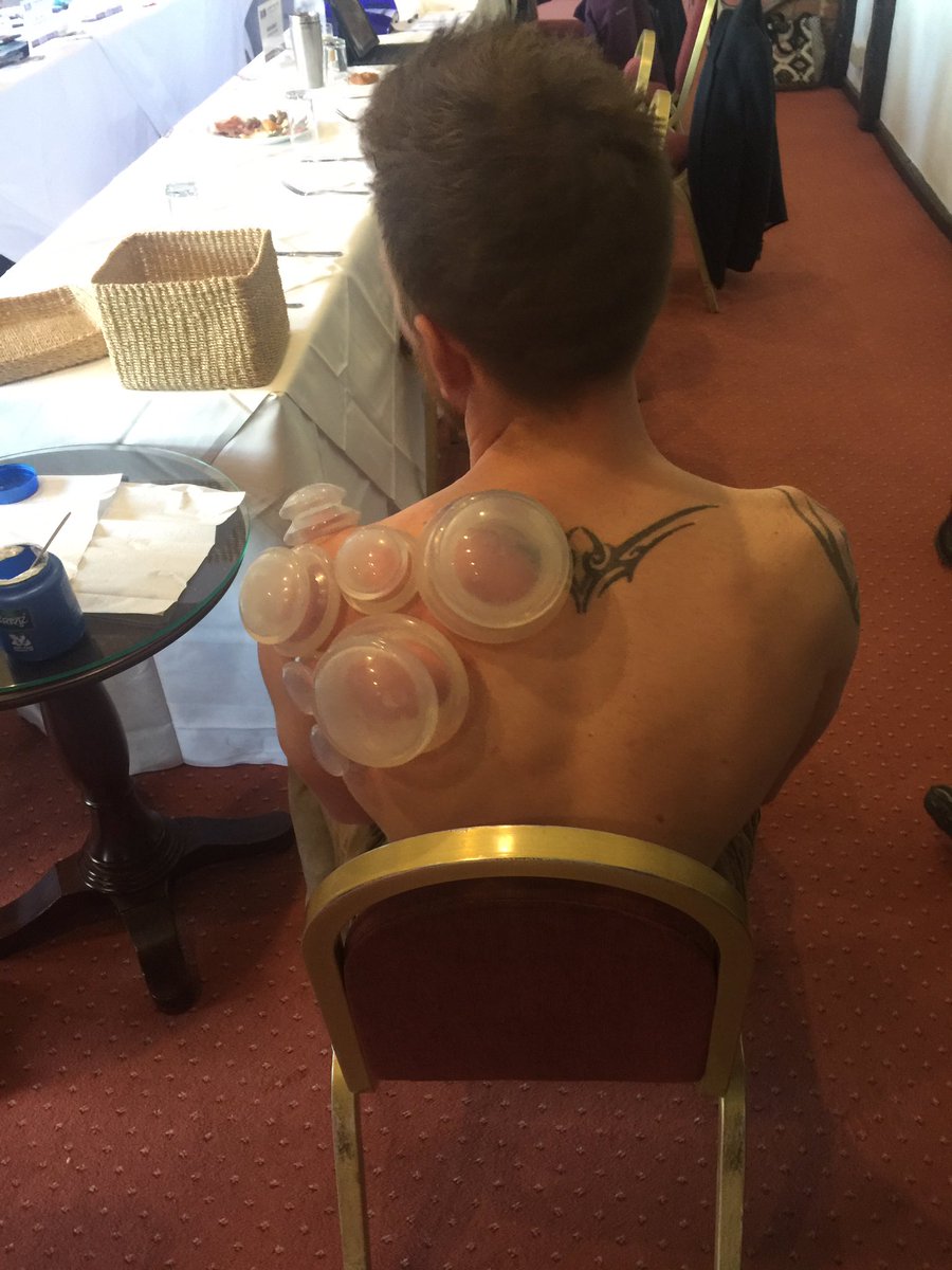 MaldonBNI's tweet photo. #cupping - the benefits are pain relief, #jointflexibility and increased blood flow to #injuries https://t.co/qo2Dl9li3h