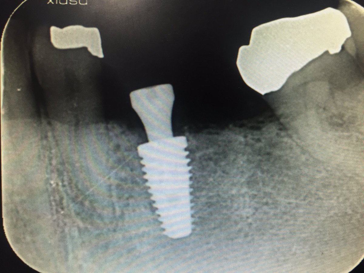 There is no other more predictable fixed treatment for a failing #bridge. Restoring patients confidence in #dentist