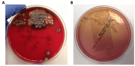 The Brief Case: Knee infection in 11 y.o. boy doesn't respond to clindamycin #JClinMicro bit.ly/21xUNhl