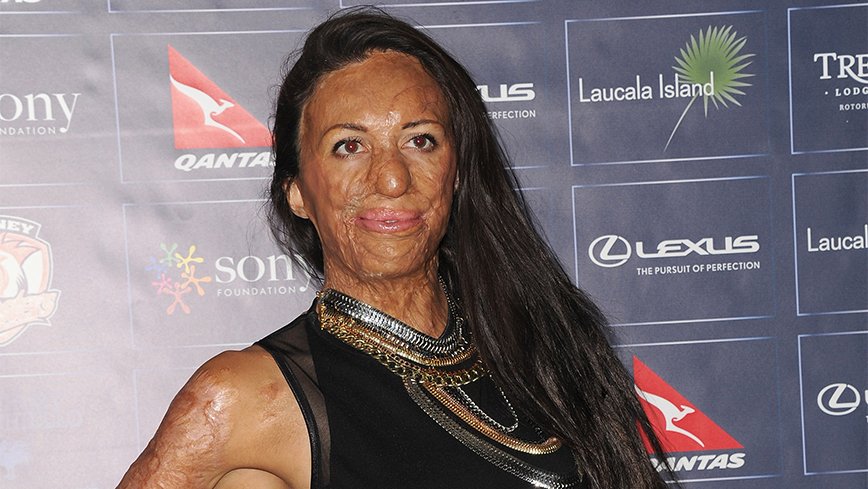 Turia Pitt talks to WHO about her next mission yhoo.it/1SZPxQb
