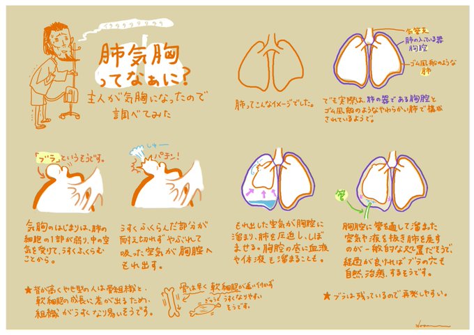 気胸のtwitterイラスト検索結果 古い順 気胸のtwitterイラスト検索結果 古い順