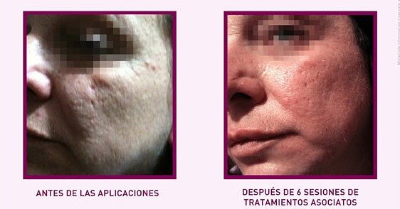corporalcore's tweet photo. PRX-T33 El protocolo para cicatrices, arrugas, poros y estrías. #corporalcore
https://t.co/yxGsRtSCH8 https://t.co/lotODmbsrh