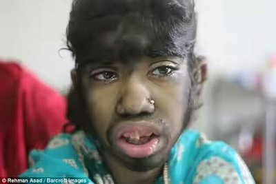FamousMixtape's tweet photo. Meet the young Bangladeshi girl who suffers from werewolf syndrome https://t.co/IIvNotK6tL https://t.co/YUIUCrgAvm