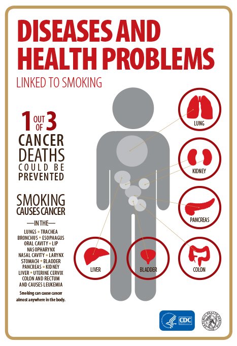 Did you know? Smoking can cause #cancer almost anywhere in the body!  https://t.co/lDyA7YIGMg