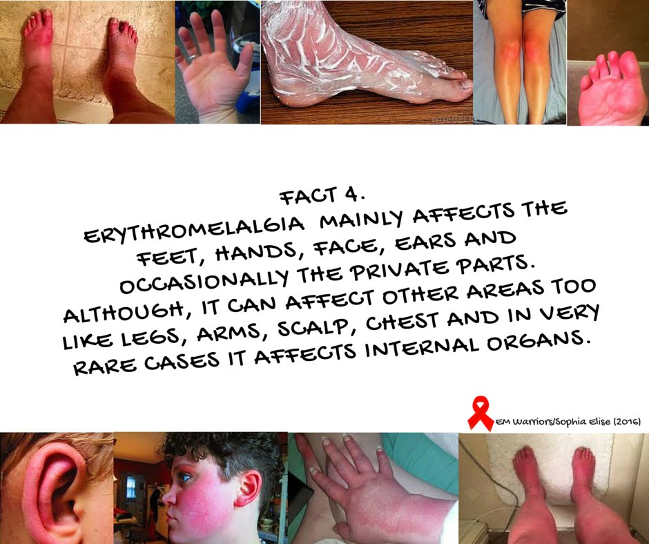 EM_Warriors's tweet photo. 1st-31st May is Erythromelalgia month. Please share and make others aware! #CureEM #erythromelalgia #RareDisease https://t.co/lpMIS6koqQ
