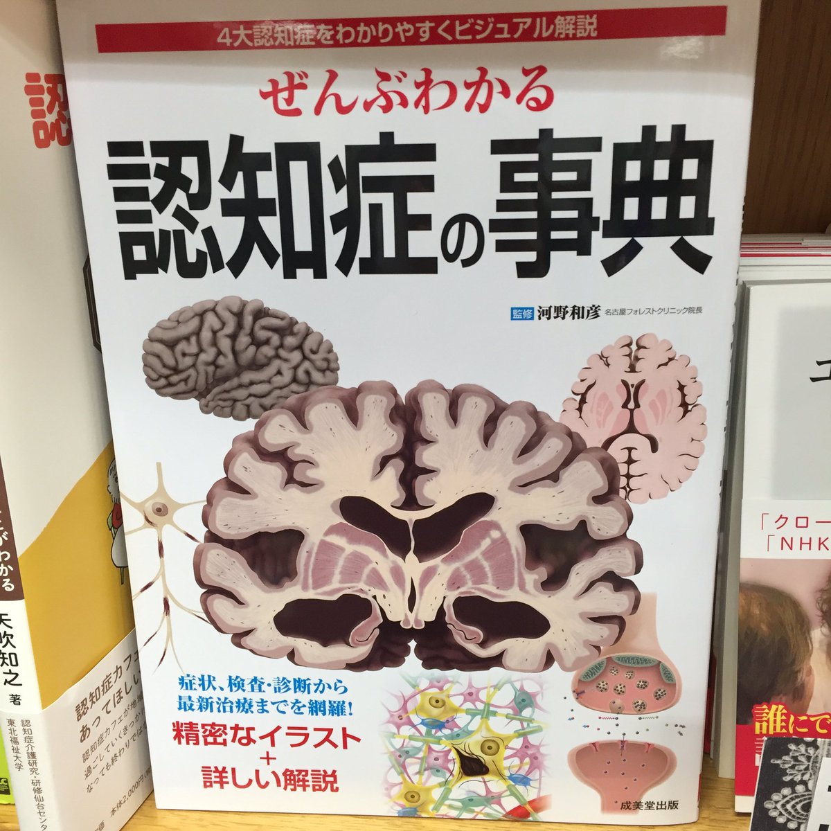 紀伊國屋書店新宿医書センター على تويتر 介護 いま注目の一冊 ぜんぶわかる 認知症の事典 成美堂出版 脳のイラスト が目を引く表紙 Mri画像を見ながらアルツハイマー型やレビー小体型認知症のメカニズムを追う新型書籍の誕生です Ak 紀伊國屋書店新宿医書センター على تويتر 介護 いま注目の一冊 ぜんぶわかる 認知症の事典 成美堂出版 脳のイラスト が目を引く表紙 Mri画像を見ながらアルツハイマー型やレビー小体型認知症のメカニズムを追う新型書籍の誕生です Ak