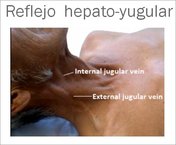 Reflujo Hepatoyugular: es la elevación de la presión venosa yugular cuando se presiona el abdomen en zona hepática.