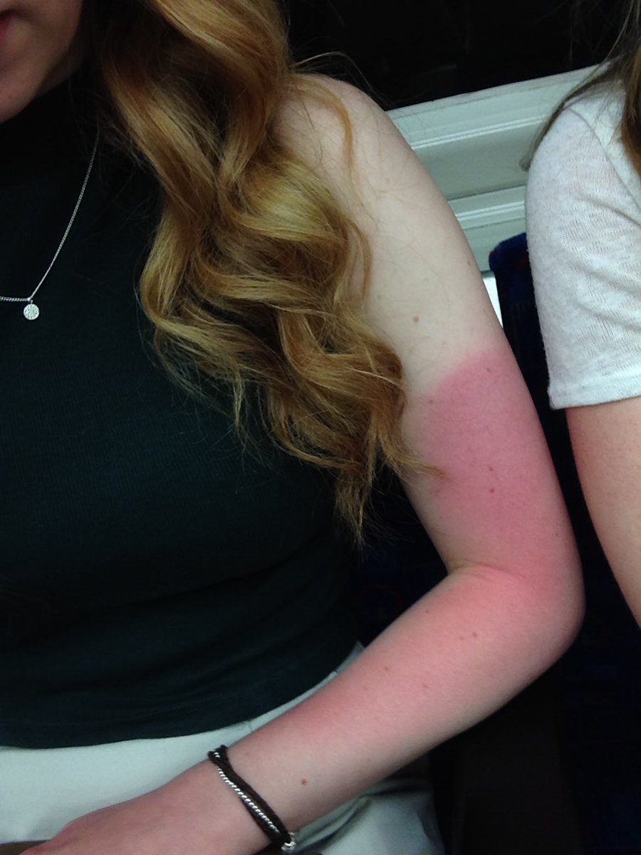 katiewilli25's tweet image. Gingers really shouldn&apos;t go in the sun... #Wooops