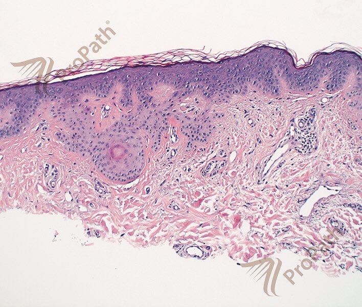 RyanHickMD's tweet photo. Glimpse of small tumor of follicular infundibulum. Wishing there was shorter name for this. #dermpath #adnexal https://t.co/bBA7E4I22H