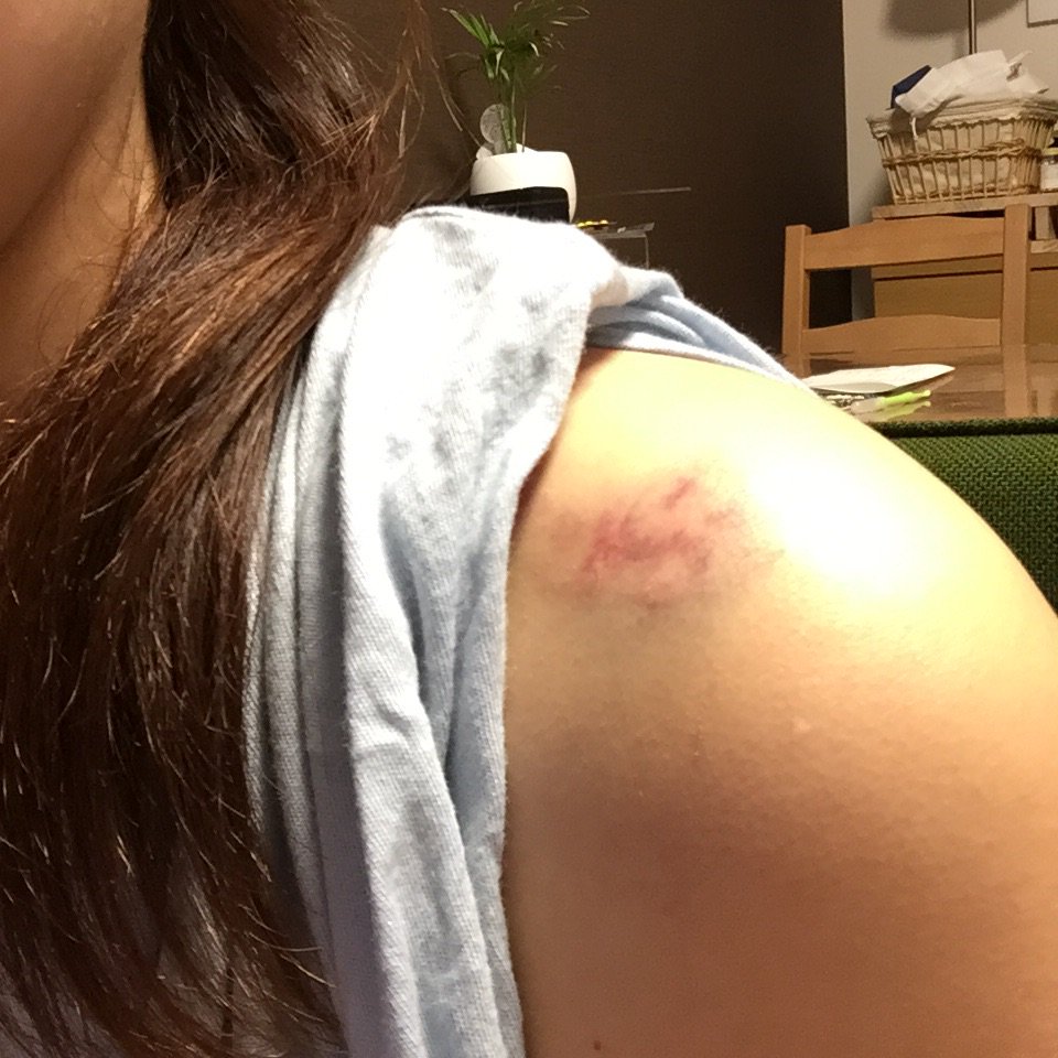 Ysk 昨日 検査で病院に行って 採血する時に袖をめくったら引っかき傷が 看護師さんにdvを疑われました 笑 今日は激しく歯型が 毎日生傷が絶えませんがdvじゃなくて 仕事です 笑 Ysk 昨日 検査で病院に行って 採血する時に袖をめくったら引っかき傷が 看護師さんにdvを疑われました 笑 今日は激しく歯型が 毎日生傷が絶えませんがdvじゃなくて 仕事です 笑