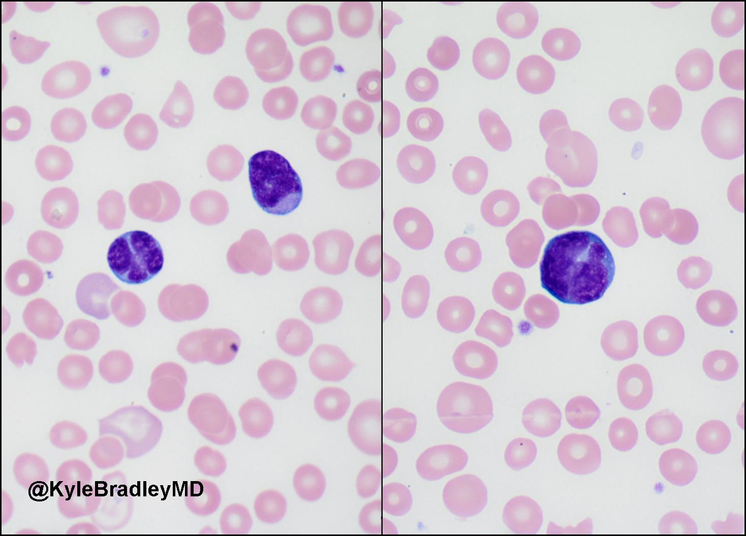 Kyle Bradley, MD on Twitter ""Flower" cells in adult Tcell leukemia