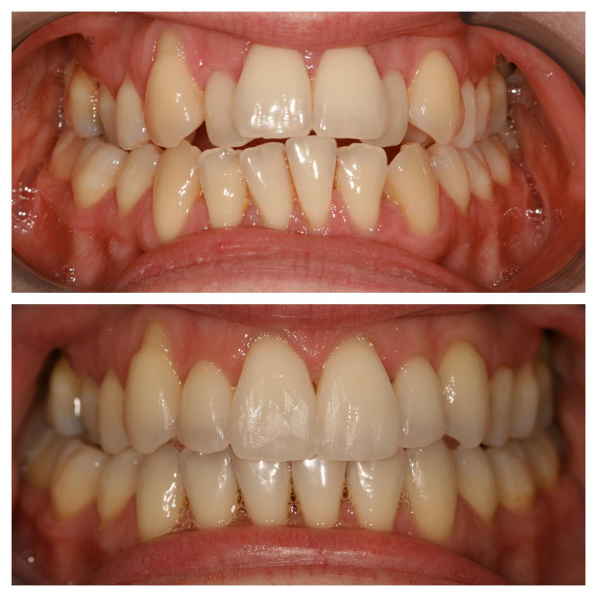 DYCwrexham's tweet photo. Check out this amazing transformation! This is one of our patients who has had #Invisalign at our practice. #wrexham https://t.co/Cw3DMjKUAY