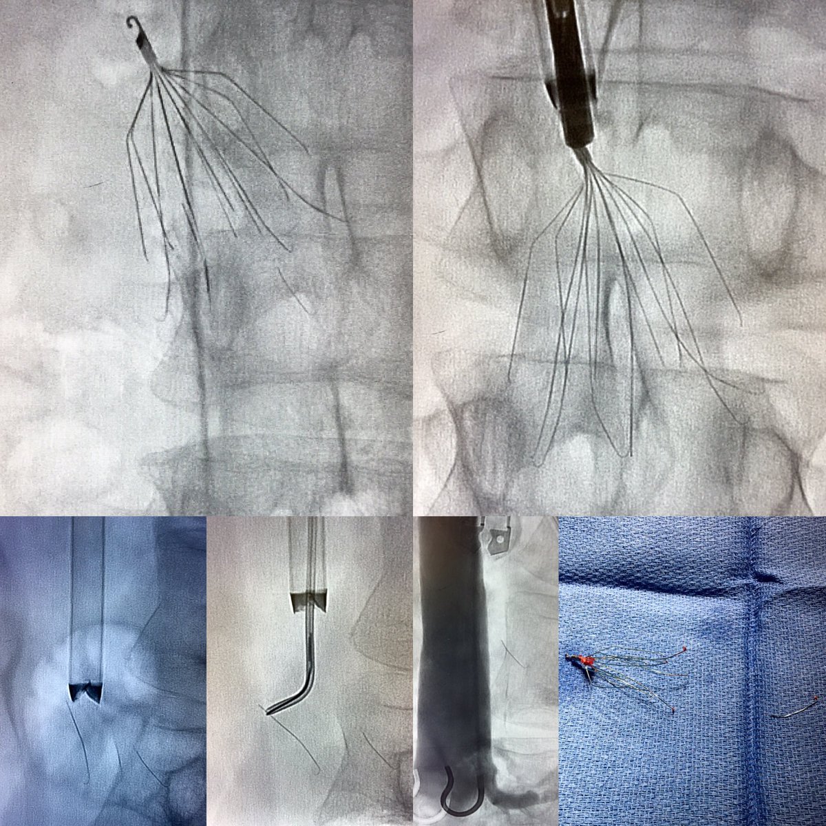 kush_r_desai's tweet image. 9 yo filter with 2 fractured struts; #filterOUT and intravascular strut out @NorthwesternIR @SIRspecialists